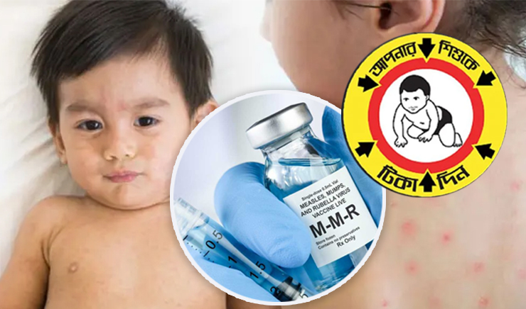 ৩০ উপজেলায় দেওয়া হচ্ছে হামের বিশেষ টিকা